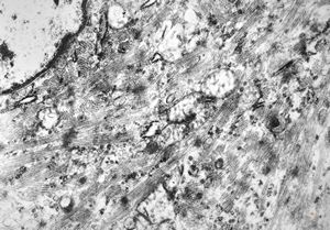 M,29y. | testis - embryonal rhabdomyosarcoma in teratoma M,29y. | testis - embryonal rhabdomyosarcoma in teratoma